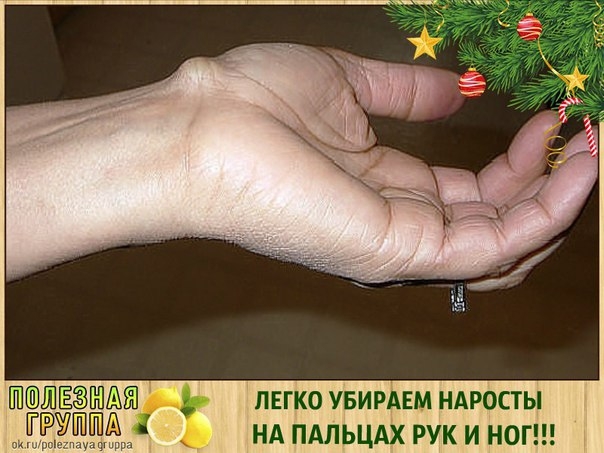 ЛЕГКО УБИРАЕМ НАРОСТЫ НА ПАЛЬЦАХ РУК И НОГ!!! ЛЕГКО УБИРАЕМ НАРОСТЫ НА ПАЛЬЦАХ РУК И НОГ!!!