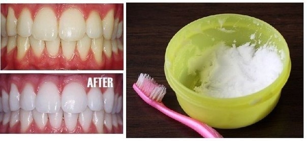 КАК ОТБЕЛИТЬ ЗУБЫ