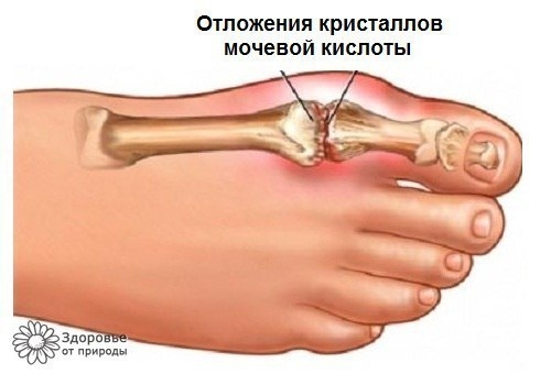 Фрукты, позволяющие снизить уровень мочевой кислоты Фрукты, позволяющие снизить уровень мочевой кислоты