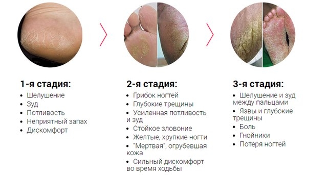 5 опасных ошибок при лечении грибка на ногах! 5 опасных ошибок при лечении грибка на ногах!