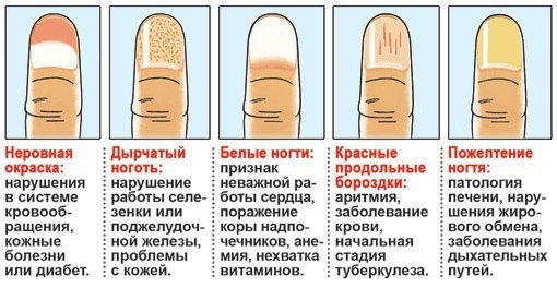Определяем заболевания по ногтям
