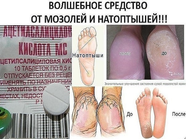 Жесткие мозоли на пятках, их еще называют "натоптыши” легко устраняются с помощью аспирина.