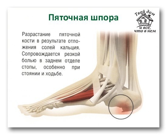 Народный рецепт лечения пяточной шпоры