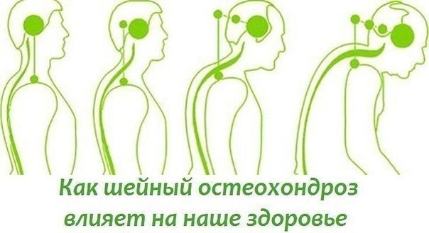 БОЛИТ ШЕЯ? КАК ШЕЙНЫЙ ОСТЕОХОНДРОЗ ВЛИЯЕТ НА НАШЕ СОСТОЯНИЕ.