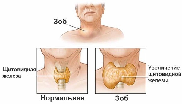 Проще простого: йод, хвойный отвар и лавровый лист. Бабушкины рецепты. Проще простого: йод, хвойный отвар и лавровый лист. Бабушкины рецепты.