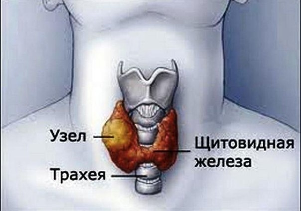 ЛЕЧИМ УЗЕЛ НА ЩИТОВИДНОЙ ЖЕЛЕЗЕ