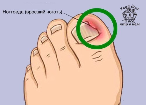 Как правильно решить проблему вросших ногтей и что такое ногтоеда?