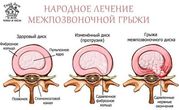 Народное лечение межпозвоночной грыжи